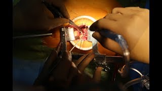 MICS CABG (Minimally Invasive CABG) by Dr Sathyaki Nambala, Apollo Hospital, Bangalore