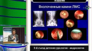 Лисенок А А - Перкутанные операции при заболеваниях почек у детей
