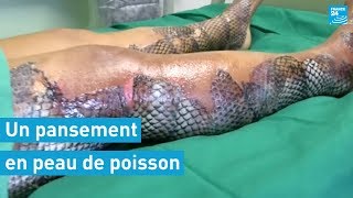 Un pansement en peau de poisson permet de soigner les grands brûlés