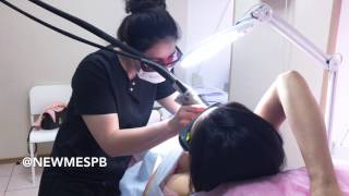 Лазерная эпиляция подмышек. Александритовый лазер CANDELA GENLELASE PRO