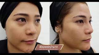 ?ฉีดฟิลเลอร์หน้าผาก ฟิลเลอร์จมูก ทำยังไง ฟิลเลอร์ และหมอต้น ปรับให้ได้ เห็นผลทันทีหลังทำ