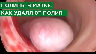 Удаление полипов. Как удаляют полип эндометрия. Полипы в матке