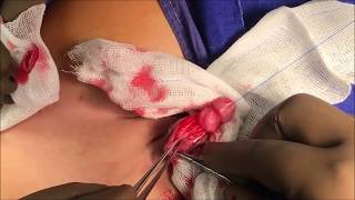 Hypospadias Repair: Real Time, Unedited