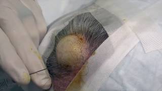 J T  is a Cyst Machine!  Dr  Gilmore's Giant Removal