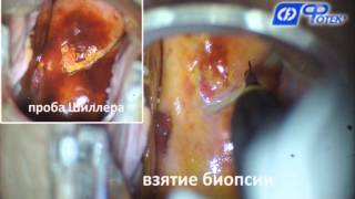 Биопсия шейки матки