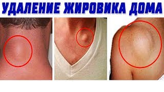 Эффективное Удаление ЛИПОМЫ [ЖИРОВИКА] на Коже, в Домашних Условиях.