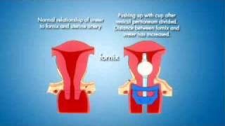 RUMI System - Coopers Surgical