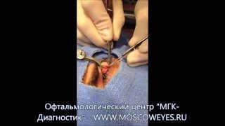 Операция по хирургическому удалению халязиона верхнего века