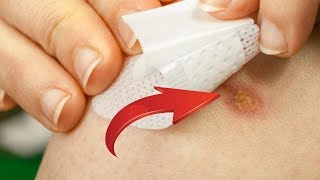 ЧУДО-СРЕДСТВО, которое быстро вытащит гной из язв и ран