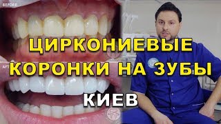 Циркониевые коронки на зубы Киев Украина (видео)