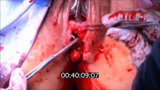 Rectovaginal Fistula Repair with Episioproctotomy and Sphincteroplasty