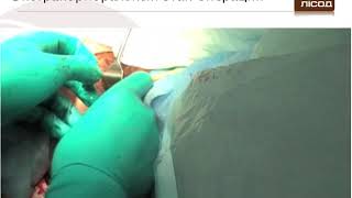NOSE (transvaginal) for rectum resections