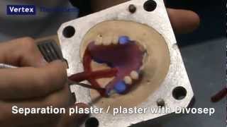 Vertex™ ThermoSens partial denture