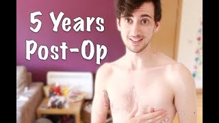 FTM Top Surgery: 5 Years Post-Op