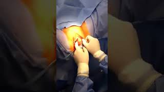 Excision of bartholin cyst. #د_أحمد_عدلي_غنيمي - #مركز_الصفا