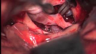 Clipping of ruptured right posterior communicating artery aneurysm