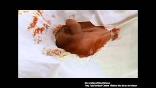 Neonatal Circumcision (in Arabic) - Dr. Sam Youssef - Tiny Tots