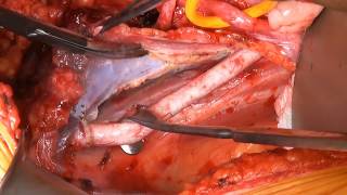 female Radical cystectomy with ileum conduit (anterior exenteration + Bricker`s operation)