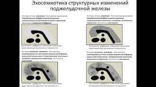 Эхосемиотика эхоструктурных изменений поджелудочной железы
