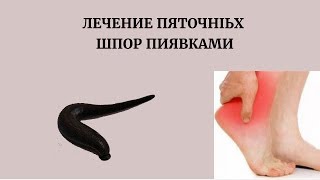 Лечение пяточных шпор пиявками