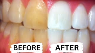 How To Whiten Teeth at Home