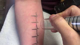 Heart beat tattoo on female, laser tattoo removal  forearm, laser tattoo removal