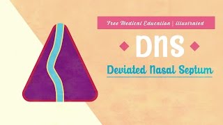 What is Deviated Nasal Septum (DNS)?