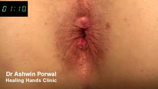 Laser Sphincterolysis for severe Anal Spasm | Cure for Anal Fissure | Dr Ashwin Porwal