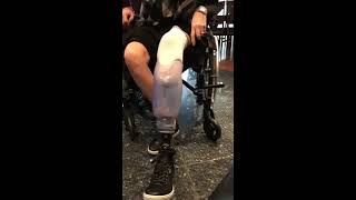 Vlog 34 At home 1st time putting on artificial leg