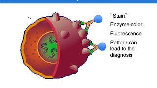 Cutaneous T-Cell Lymphoma