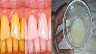 কিভাবে দাঁতের কালো দাগ দূর করবেন । দাঁত কে সাদা ঝকঝকে করে নিন-Best Ways To Whiten Teeth Naturally