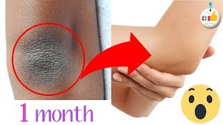 কনুই এর কালো দাগ তোলার সহজ উপায় || কিভাবে কনুই এর কালো দাগ দূর করবেন তার উপায় || Best Tag ||