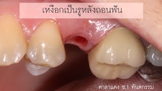 เหงือกเป็นรู หลังผ่าฟันคุด