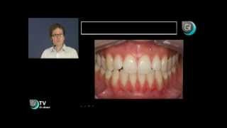Implants dentaires : Les récessions mandibulaires