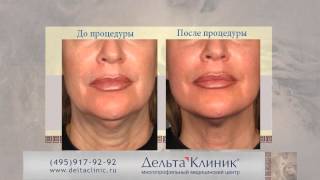 Подтяжка кожи лица без операции Ulthera System в Дельта Клиник