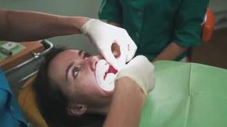 Фиксация брекетов. Самолигирующиеся брекеты.
