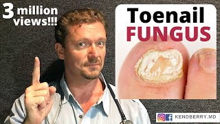 How to CURE Toenail Fungus (And keep it Gone FOREVER)