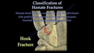 Hamate Fractures - Everything You Need To Know - Dr. Nabil Ebraheim