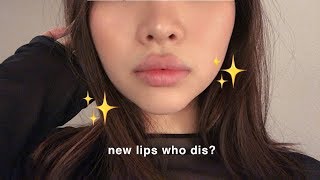 ?Trying Lip Fillers for the First Time!! @ LaserAway