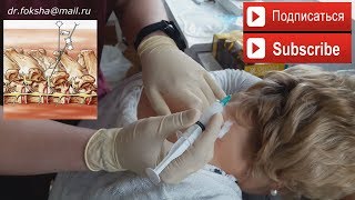 Лечение ОСТЕОХОНДРОЗА | БЛОКАДА | Cervical Injections