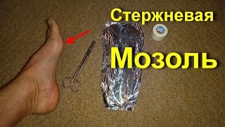 Шипица - подошвенная мозоль со стержнем. Как лечить мозоли. Все это сгинет на нет навсегда от фольги