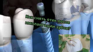Как снять отек после имплантации зубов?