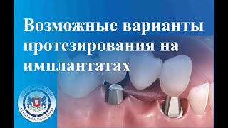 Возможные варианты протезирования на имплантатах