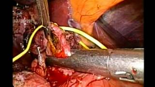 Laparoscopic excision of Choledochal cyst with intracorporeal Roux-en-Y hepaticojejunostomy for chol