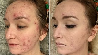 Макияж для АКНЕ / Vichy Dermablend 3D. #PROнеуверенность