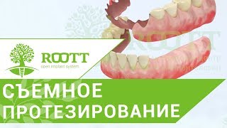 Съемное протезирование. ?Частично - съемное протезирование после удаления зуба. ROOTT.