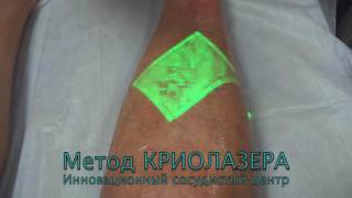 Лазерное удаление сосудов - Криолазер