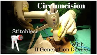 Stitchless Circumcision with II GenStapler by Dr.Sachin Kuber Call +919370275336/+919370240098