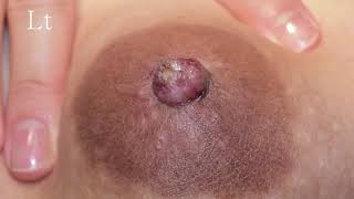 Inverted Nipple Correction without incision in Korea