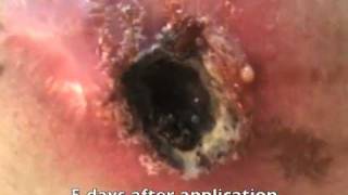 Black Salve Cancer